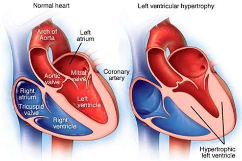 left ventricular prominence